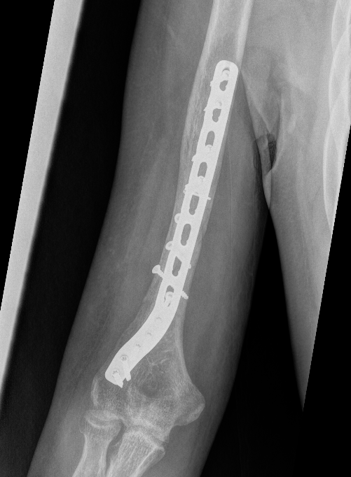 Humerus distal posterolateral plate 1
